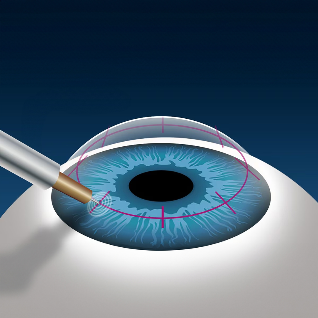 Keratoplasty